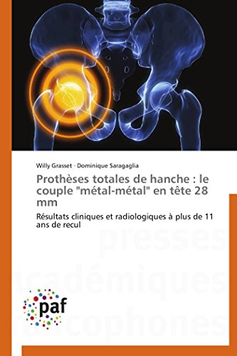 9783838175072: Prothses totales de hanche : le couple "mtal-mtal" en tte 28 mm