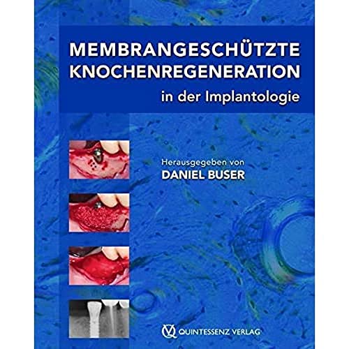 9783868670103: Membrangeschtze Knochenregeneration in der Implantologie