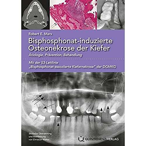 9783868671070: Bisphosphonat-induzierte Osteonekrose der Kiefer: tiologie, Prvention, Behandlung