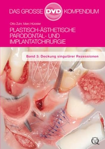 9783868671483: Plastisch-sthetische Parodontal- und Implantatchirurgie: Band 3: Deckung singulrer Rezessionen [Alemania] [DVD]