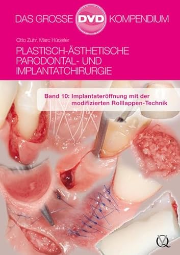 Plastisch-Ästhetische Parodontal- und Implantatchirurgie : Band 10: Implantateröffnung mit der modifizierten Rolllappen-Technik - Otto Zuhr