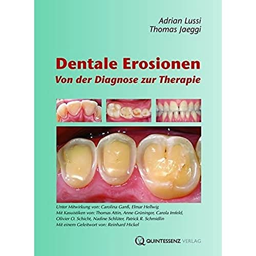 9783938947081: Dentale Erosionen: Von der Diagnose zur Therapie