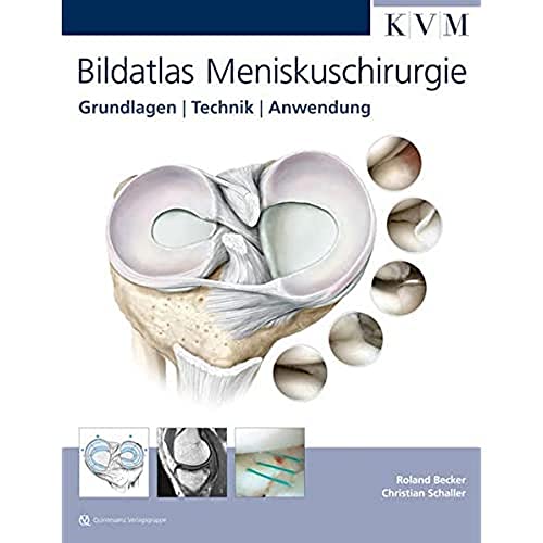Beispielbild fr Bildatlas Meniskuschirurgie: Grundlagen | Technik | Anwendung zum Verkauf von medimops