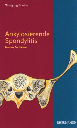 Beispielbild fr Ankylosierende Spondylitis: Morbus Bechterew zum Verkauf von medimops