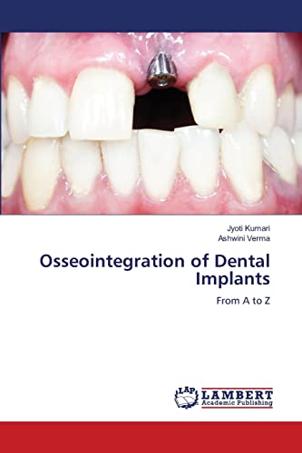 Stock image for Osseointegration of Dental Implants: From A to Z for sale by California Books