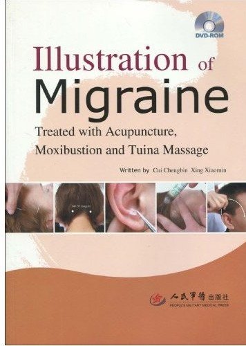 9787509130834: Illustration of Migraine: Treated with Acupuncture, Moxibustion and Tuina Massage