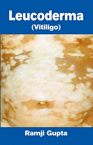 9788126908059: Leucoderma Vitiligo