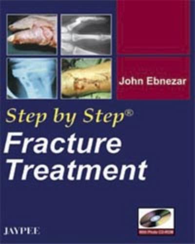 9788184482546: Step by Step: Fracture Treatment