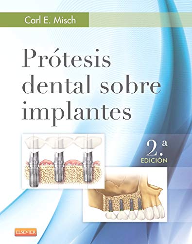 9788490228630: Prtesis dental sobre implantes - 2 Edicin