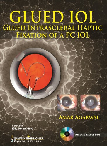Stock image for Glued IOL: Glued Intrascleral Haptic Fixation of a PC Iol for sale by ThriftBooks-Atlanta