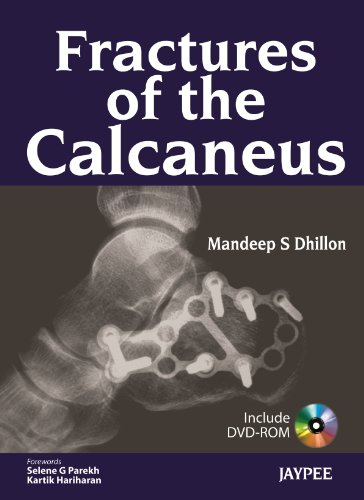 Imagen de archivo de Fractures of the Calcaneus a la venta por Books Puddle