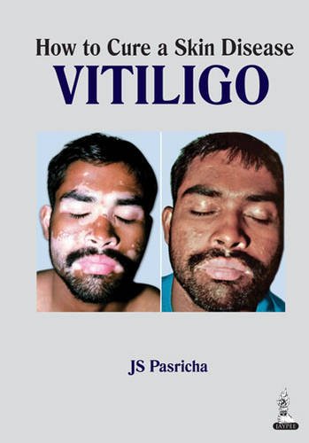 Stock image for How to Cure a Skin Disease: Vitiligo for sale by GF Books, Inc.