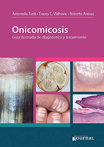 Stock image for Onicomicosis (Spanish Edition) for sale by GF Books, Inc.