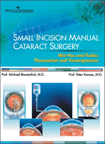 Small Incision Manual Cataract Surgery (9789962613244) by Blumenthal, Michael; Kansas, Peter